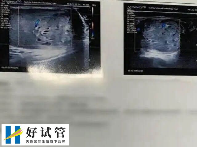 子宫内膜的厚度对于试管的成功至关重要